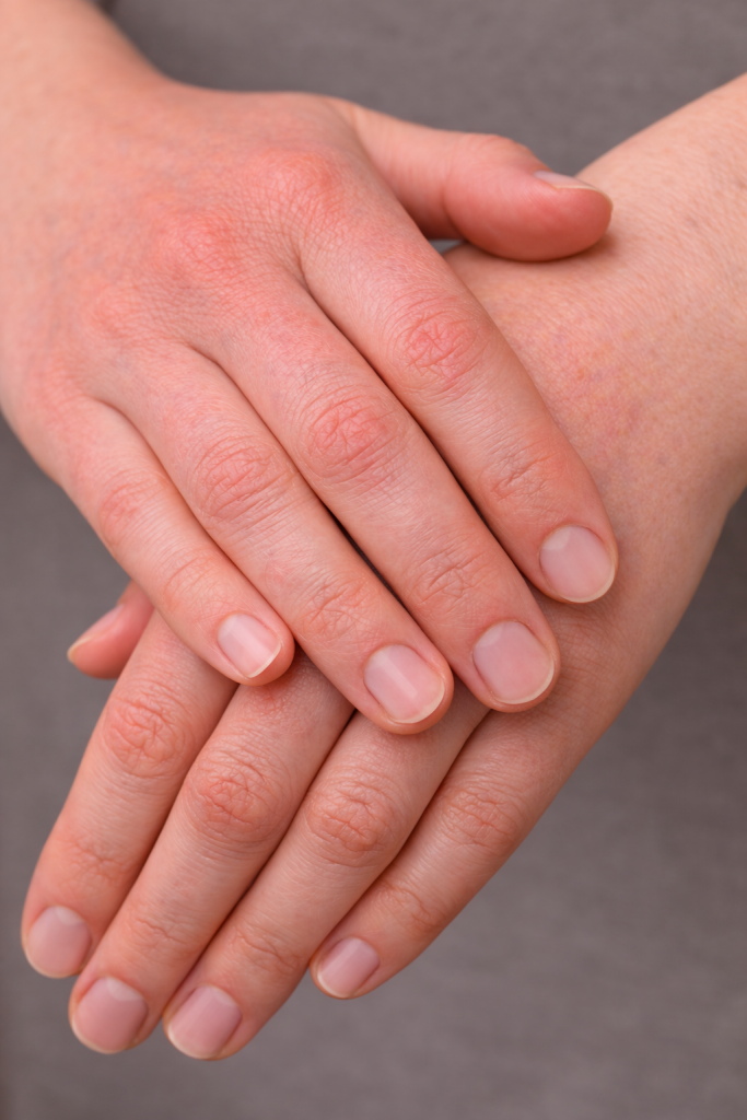 Покраснение/раздражение кожи (пример)