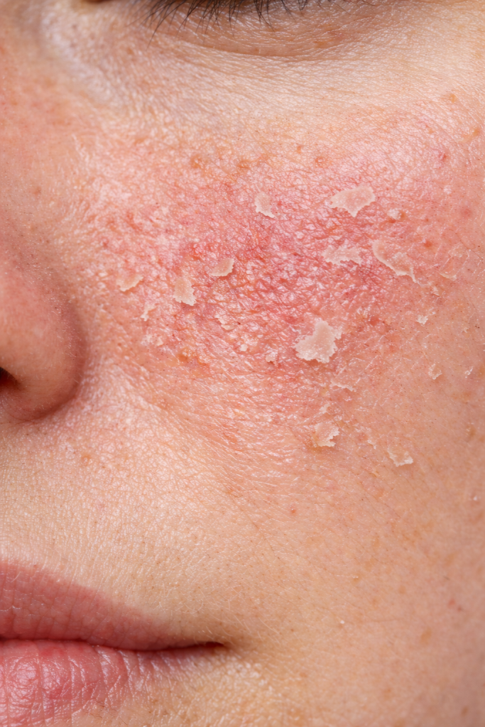 Повреждённый кожный барьер (покраснение/шелушение)